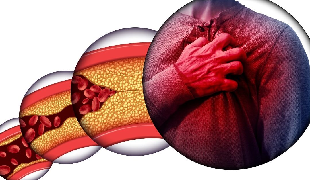 Atherosclerosis the Unseen Invader in Cardiovascular System