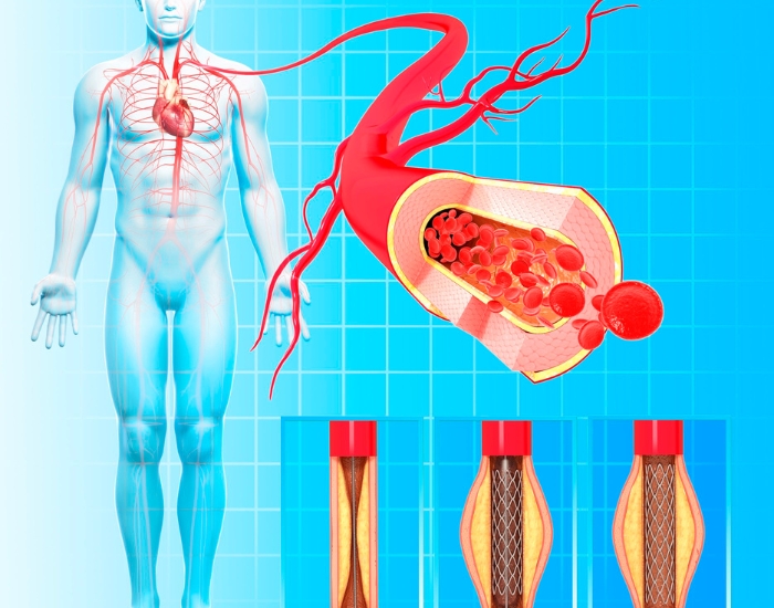 Coronary Angioplasty & Stent Implant