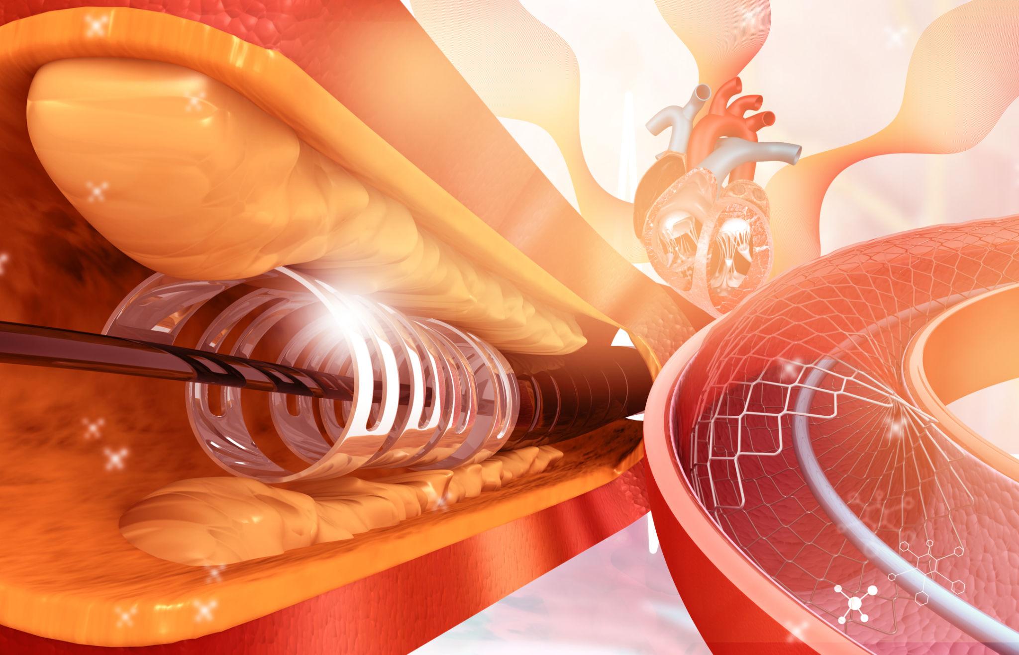 Chest pain during walking showing angina symptoms caused by blocked heart arteries