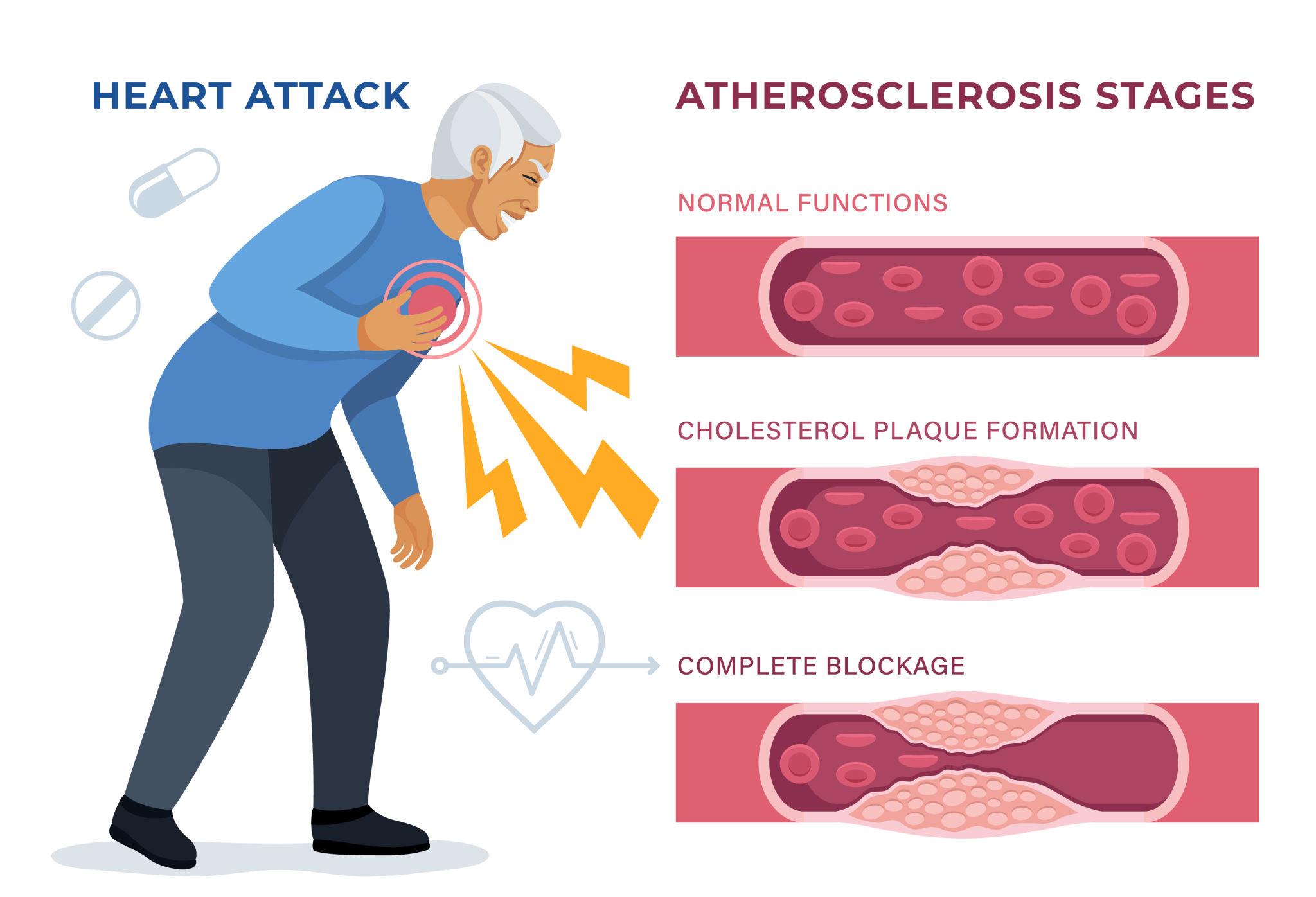 Detailed illustration of blocked arteries in heart showing plaque buildup and reduced blood flow